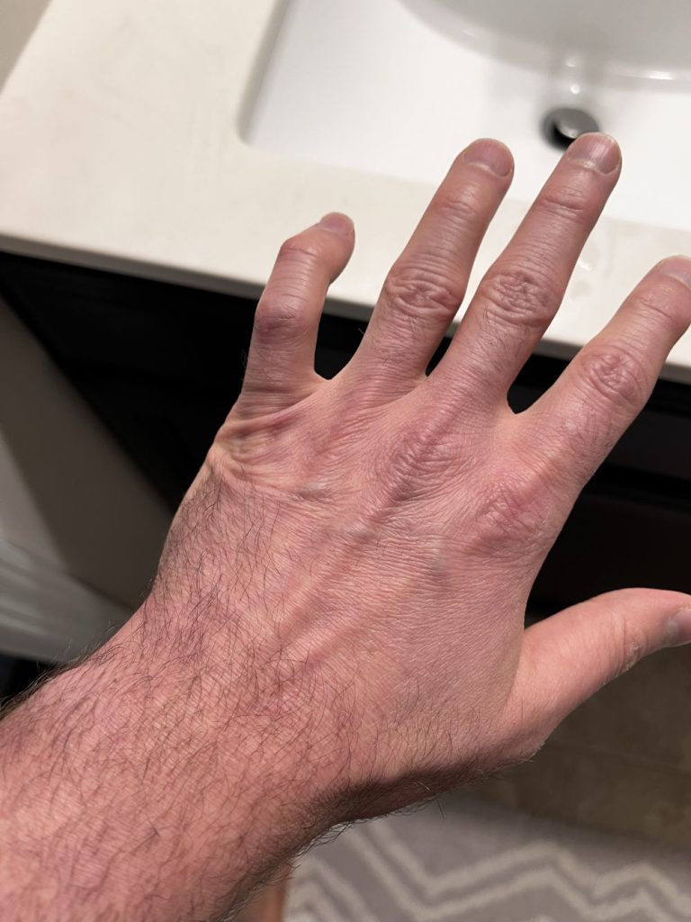 My Health Scare